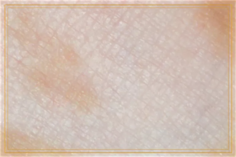 青少年手掌出现白癜风咋治效果好