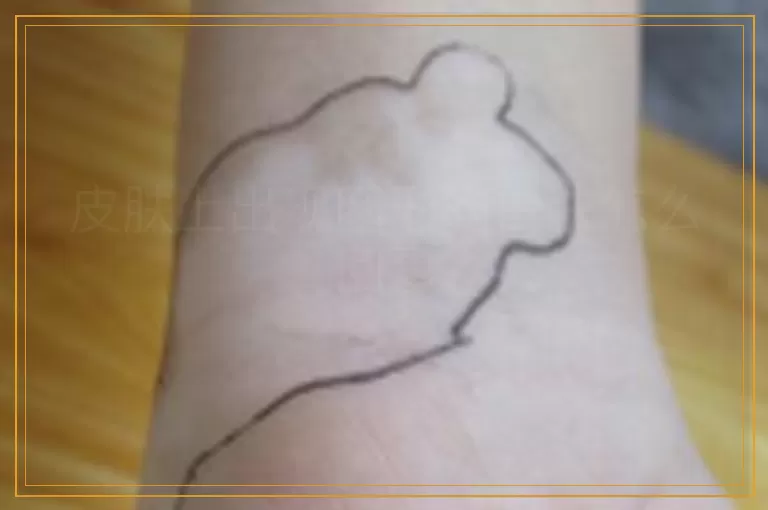 皮肤上出现圆形的白块怎么回事