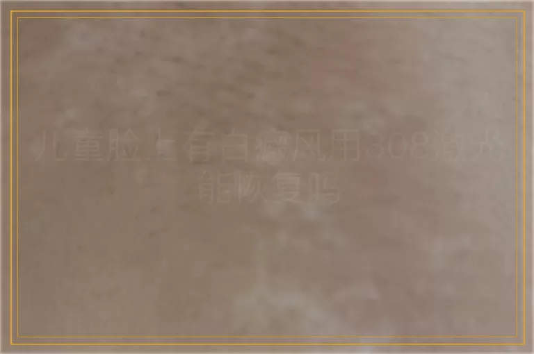 儿童脸上有白癜风用308激光能恢复吗