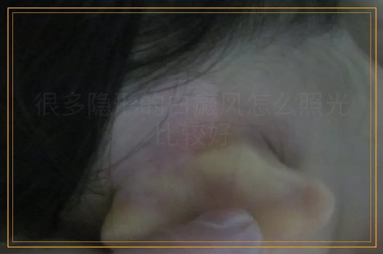 很多隐形的白癜风怎么照光比较好