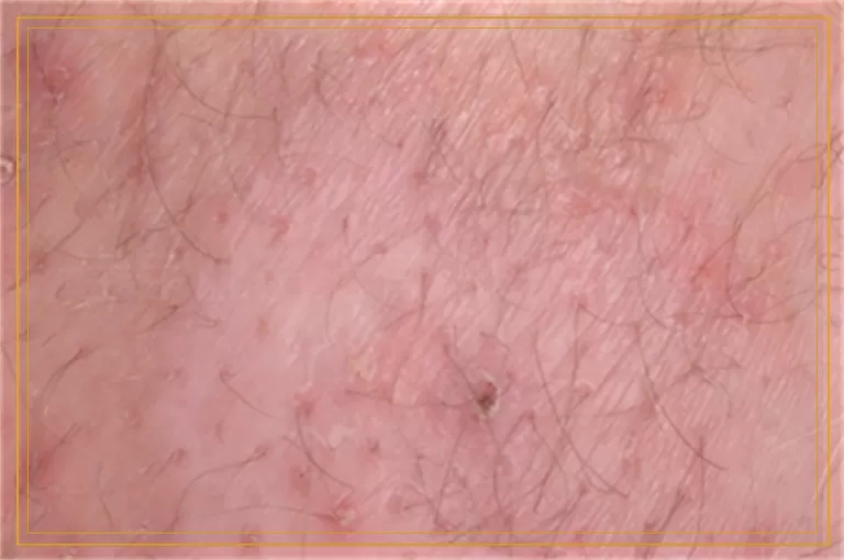 宝宝肚子上有小白点怎么办