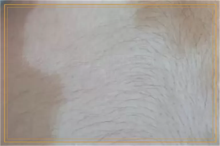 拔火罐治疗对白癜风有帮助吗