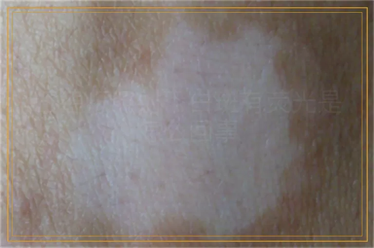 伍德灯照射下白斑有荧光是怎么回事