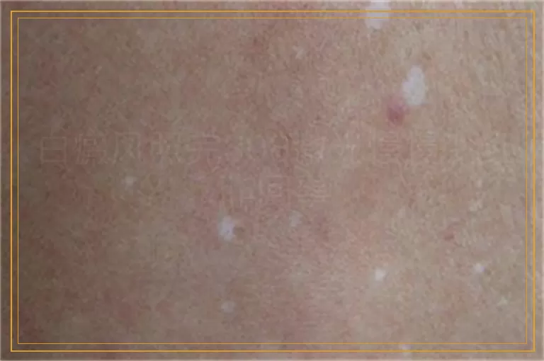 白癜风照完308激光慢慢变红咋回事