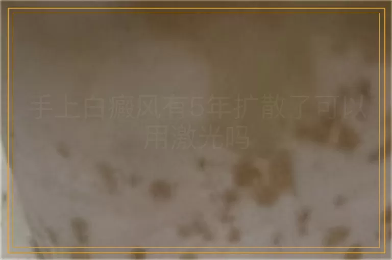 手上白癜风有5年扩散了可以用激光吗