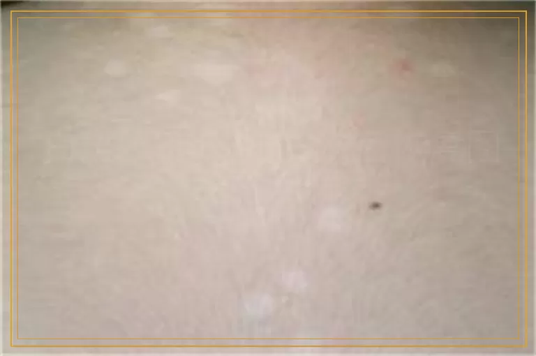 白斑照308激光8次后恢复图是什么样