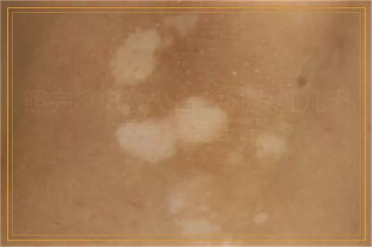 照完308激光白癜风发红几天才会恢复正常