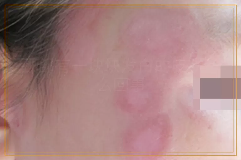 颈部有一块块发白的皮肤怎么回事