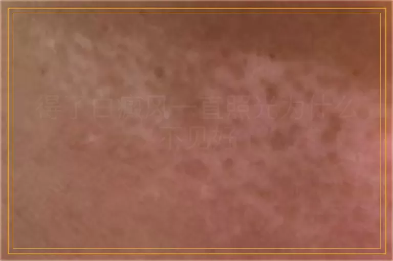 得了白癜风一直照光为什么不见好