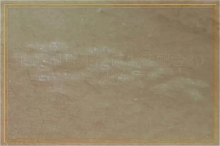 白癜风能不能做火针配合308激光治疗