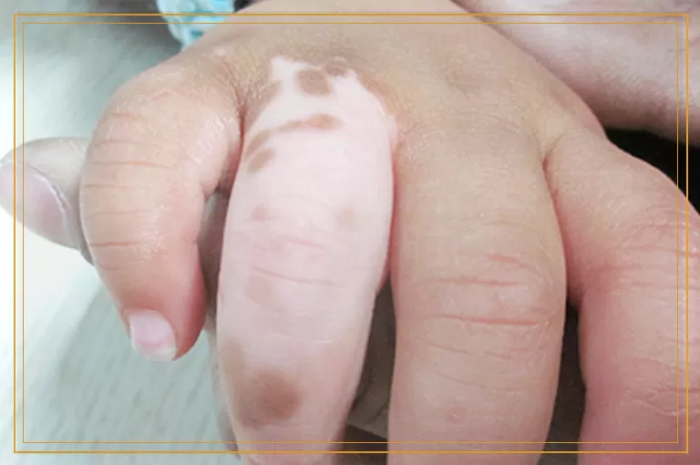 为什么有的患者治疗白癜风花这么长时间