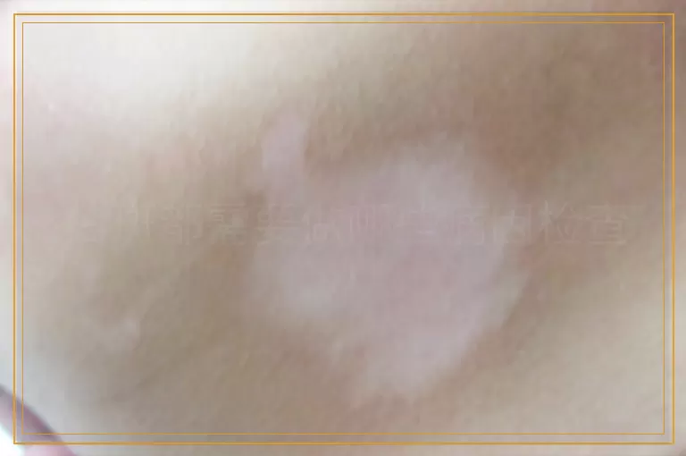 白斑都需要做哪些病因检查