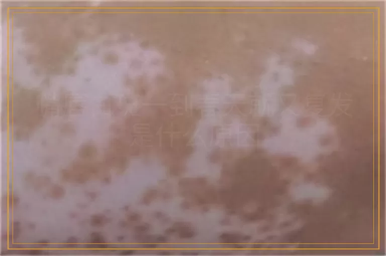 嘴唇白斑一到春天就又复发是什么原因