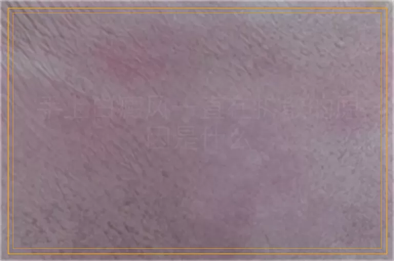 手上白癜风一直在扩散的原因是什么