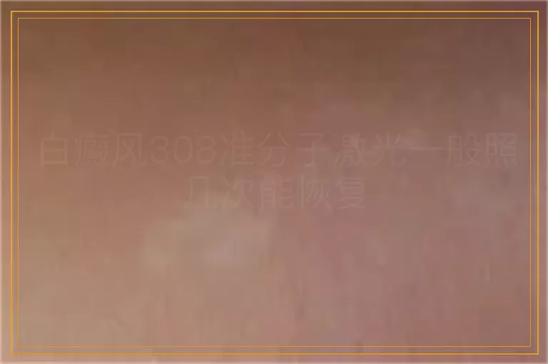 白癜风308准分子激光一般照几次能恢复