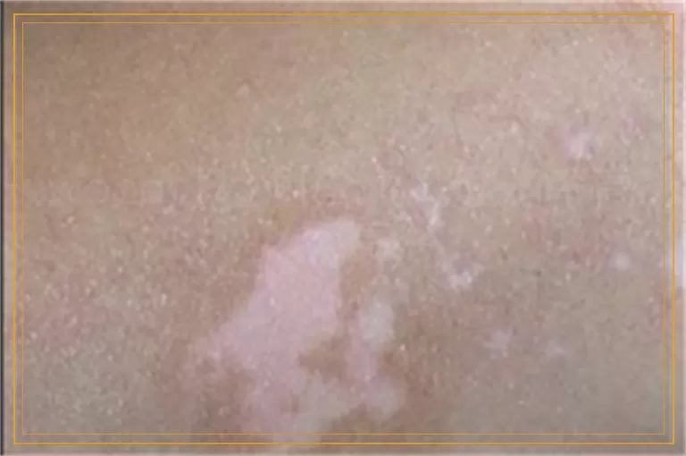 wood灯检测白癜风准确率高不高