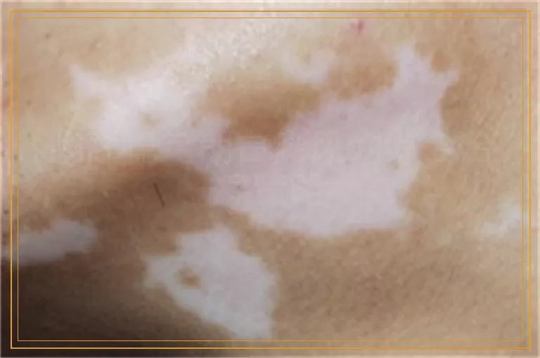 胸部稳定期白癜风的综合治疗策略