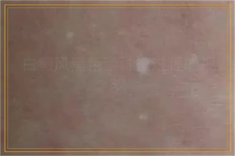 白癜风黑色素种植过程的视频