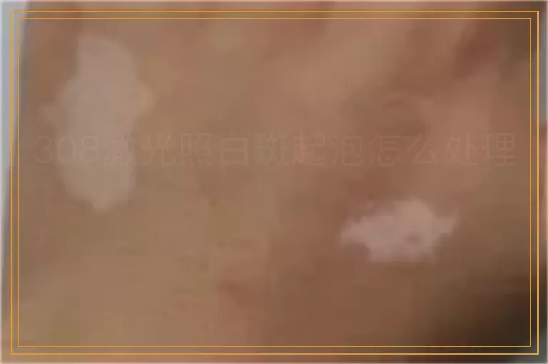 308激光照白斑起泡怎么处理