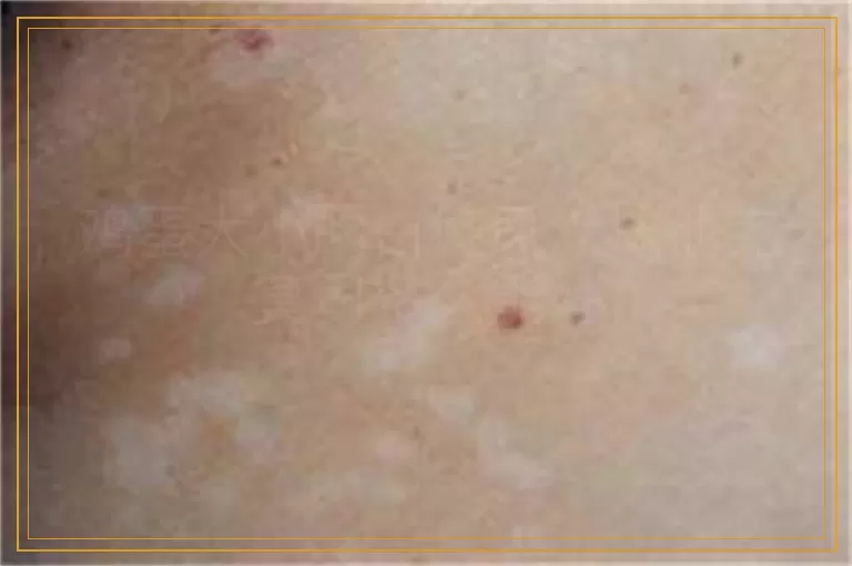 鸡蛋大小的白癜风涂抹他克莫司多久能好