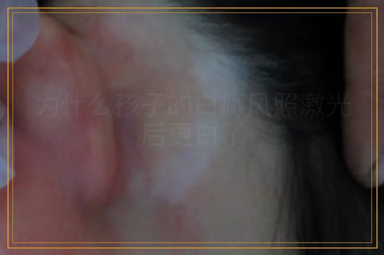 为什么孩子的白癜风照激光后更白了