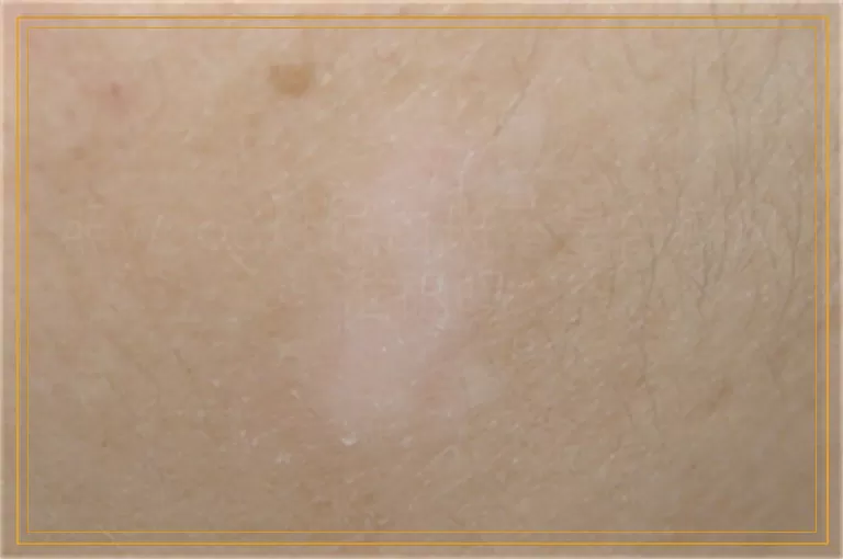 照wood灯说白斑不是白癜风准确吗