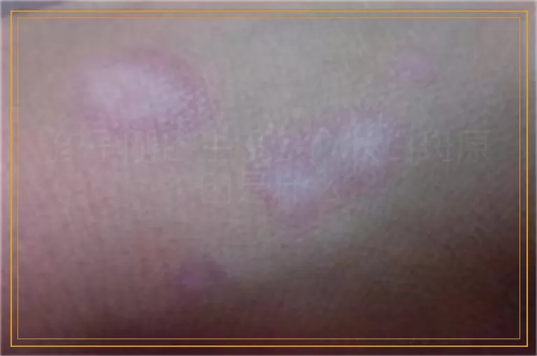 孩子刚出生没多久长白斑原因是什么