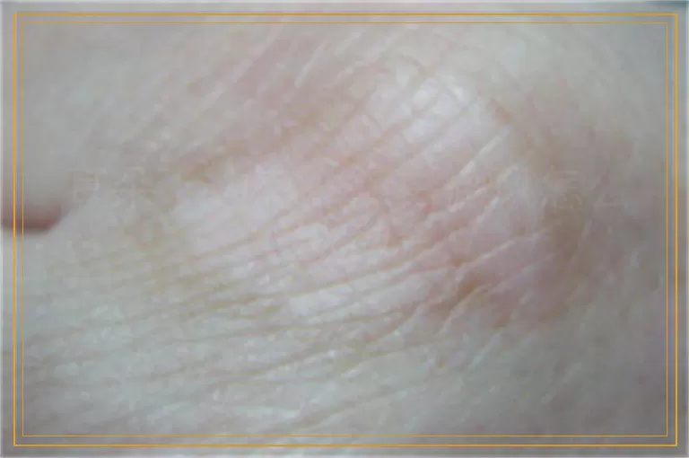 耳朵下边有一点白癜风怎么治疗好