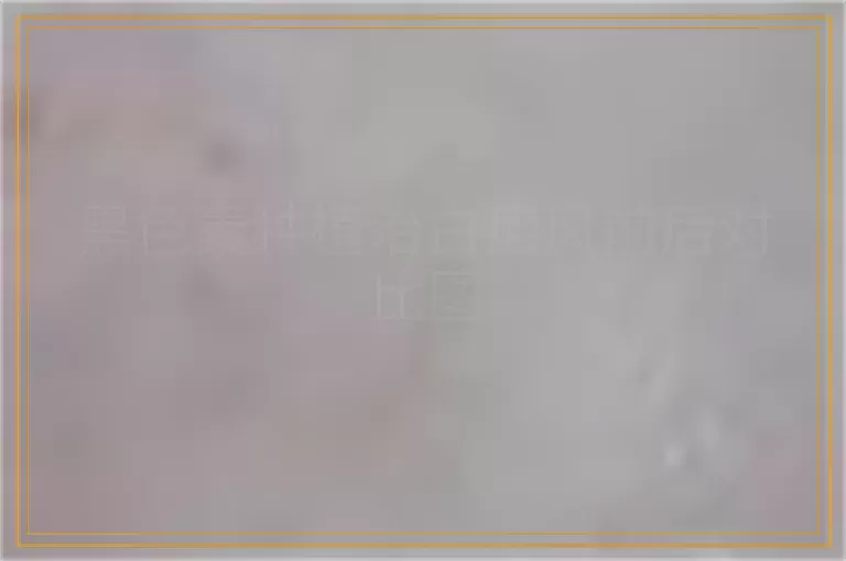 黑色素种植治白癜风前后对比图
