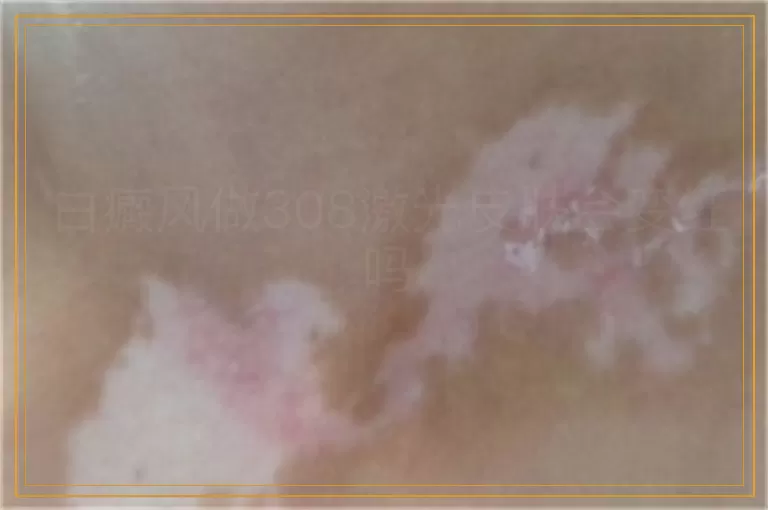 白癜风做308激光皮肤会变红吗