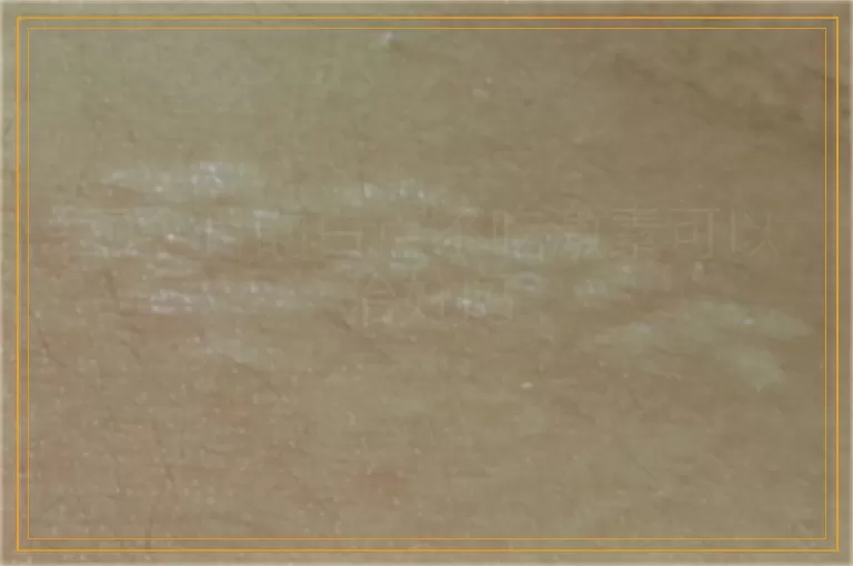 三个月的白点不吃激素可以治好吗