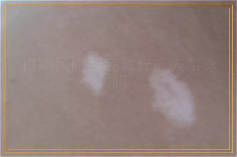 白癜风刚照完激光能去游泳吗
