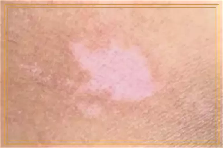 白癜风一个光斑大小能治好吗