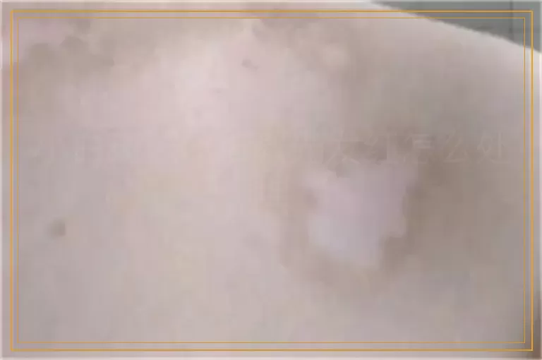 小白斑照308激光发红怎么处理