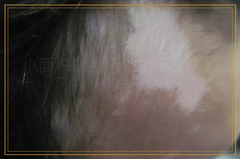 小面积白癜风做植皮多久能好