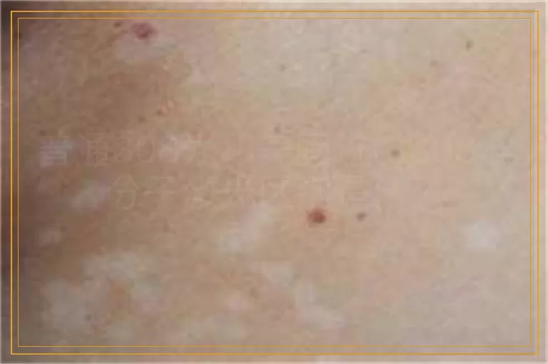 普通308光和美国进口308准分子激光区别是什么