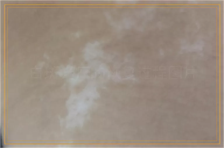 白斑光疗的恢复过程图片