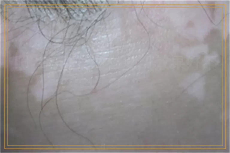 照308激光对白癜风效果好不好