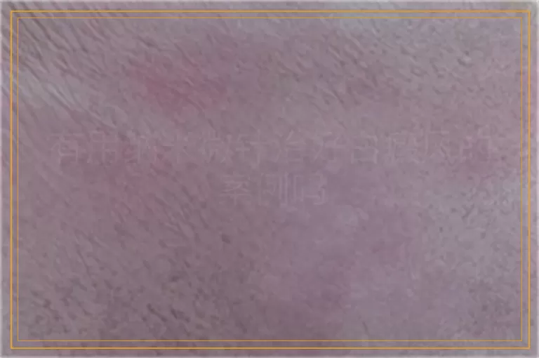 有用纳米微针治好白癜风的案例吗