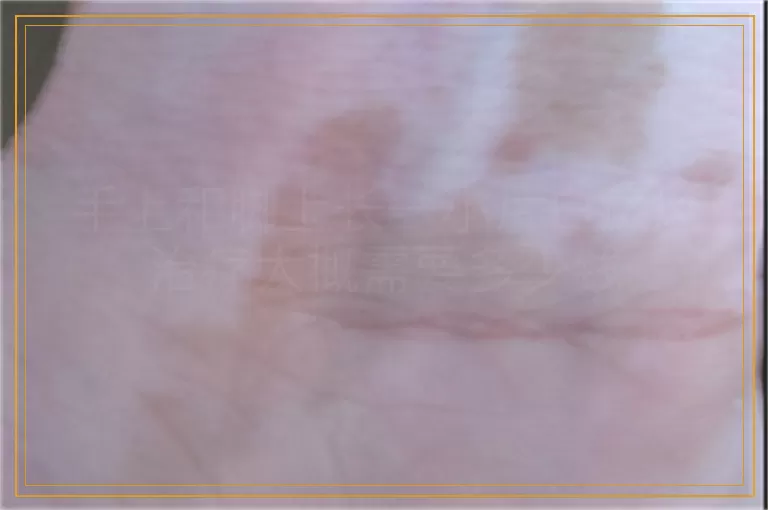 手上和脚上长一小片白癜风治疗大概需要多少钱