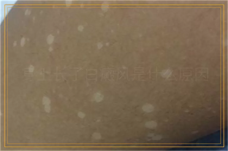 身上长了白癜风是什么原因