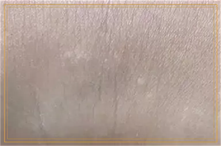 青少年治疗白癜风用什么方法安全效果好