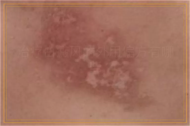 治疗白癜风的外用偏方有哪些