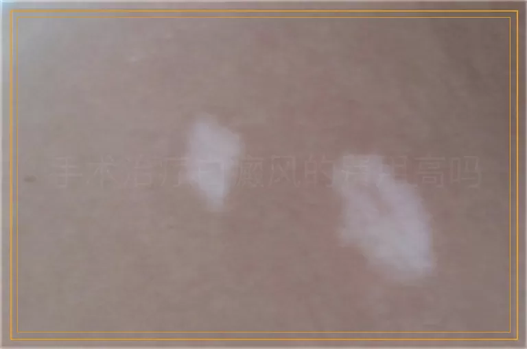 手术治疗白癜风的费用高吗