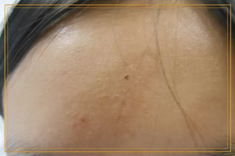 一般308激光医治白癜风多久才能好