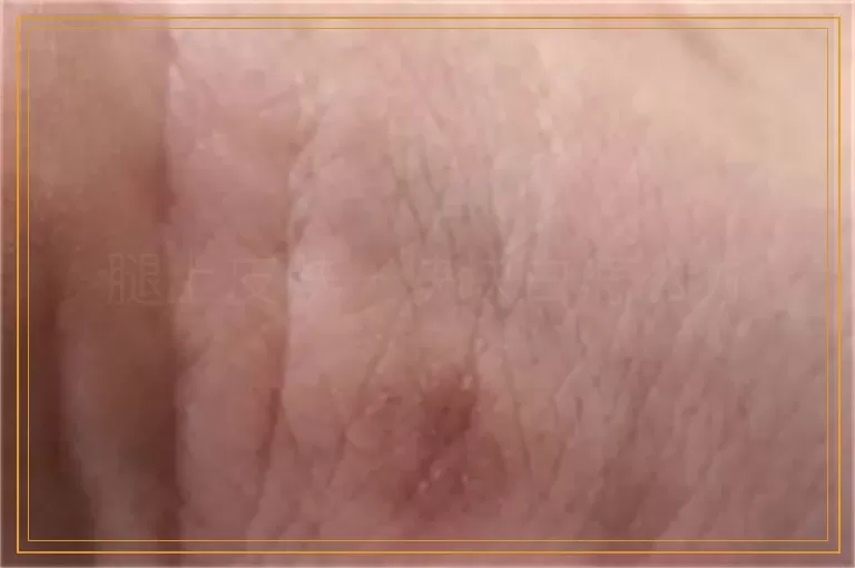 腿上皮肤一块块白怎么办