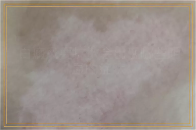 白癜风要扩散会出现哪些明显的症状