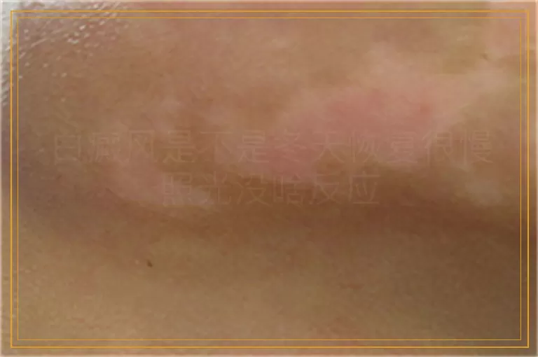 白癜风是不是冬天恢复很慢照光没啥反应