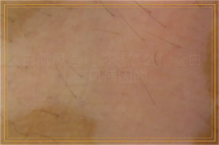 白癜风医院都是怎么检查白癜风病因的