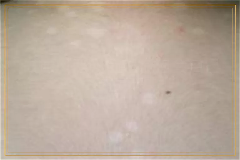 白癜风照光后起泡泡会自己消失吗